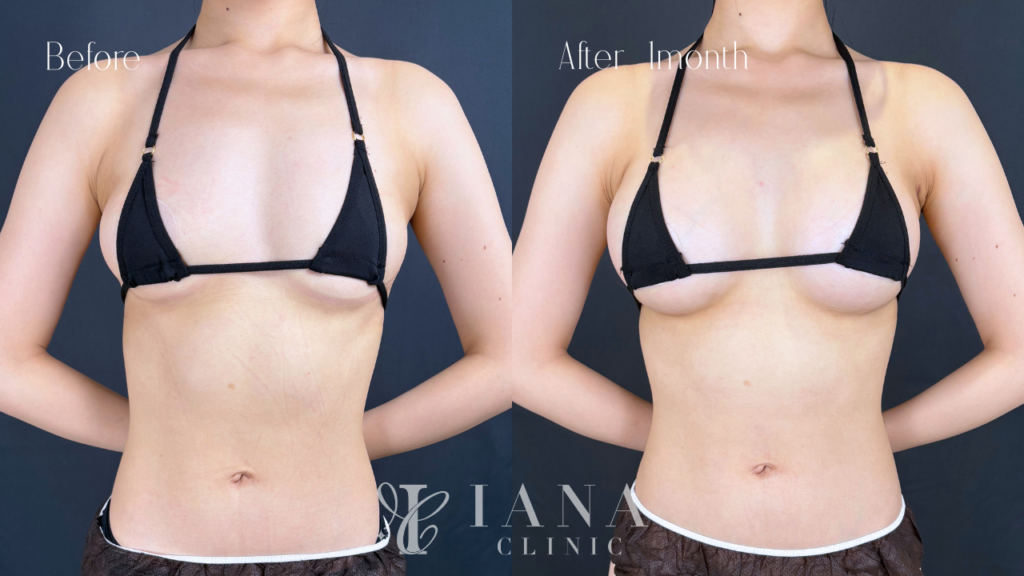 シリコンバック豊胸