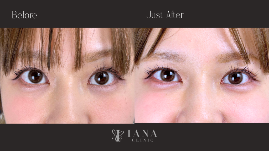 ヒアルロン酸