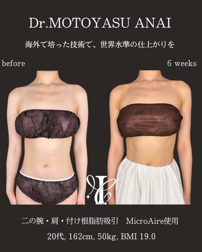 二の腕+肩+付け根脂肪吸引 術後6週間の症例②(正面)