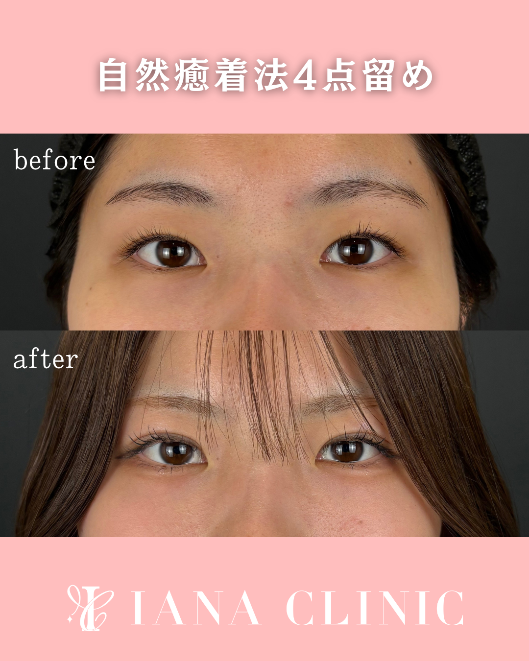 二重埋没法(自然癒着法)4点留め 術前術後1ヶ月 比較写真
