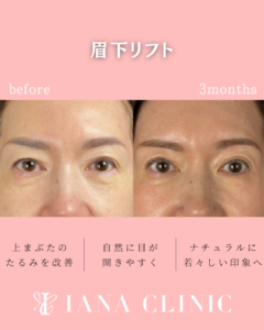 眉下リフト 術前術後3ヶ月 比較写真