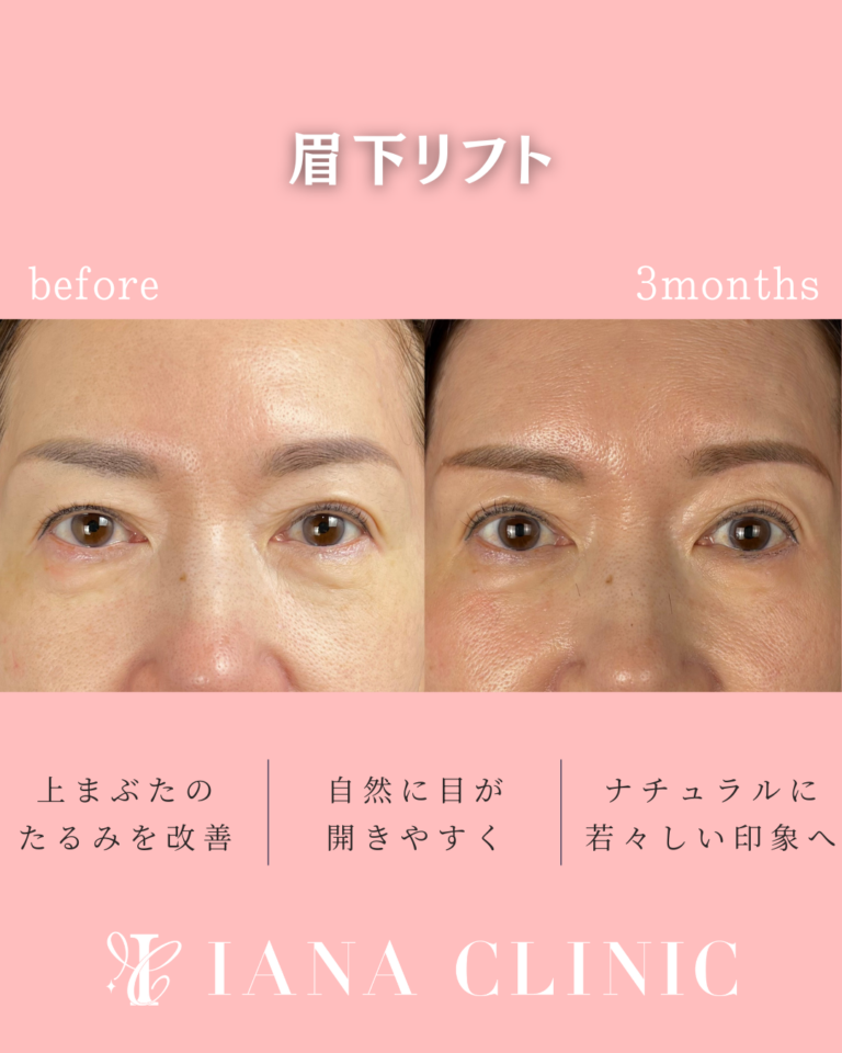 眉下リフト 術後3ヶ月の症例①