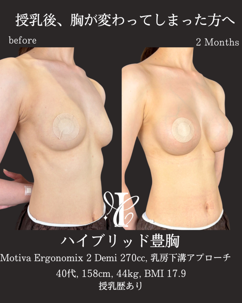 ハイブリッド豊胸(Motiva Demi 270cc) 術後2ヶ月の症例①