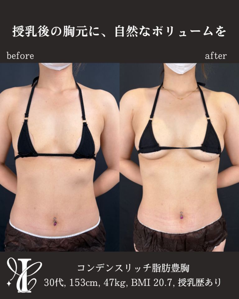 コンデンスリッチ脂肪豊胸 術後3ヶ月の症例②