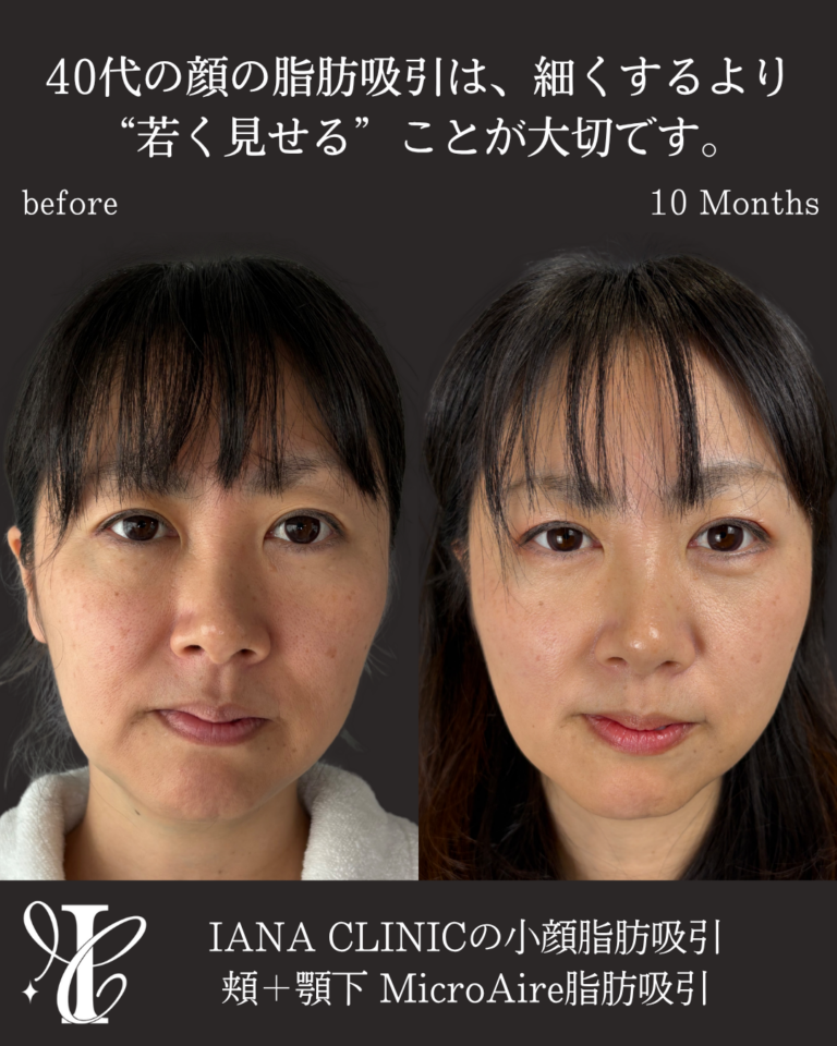 アゴ下+ホホ脂肪吸引 術後10ヶ月の症例⑤