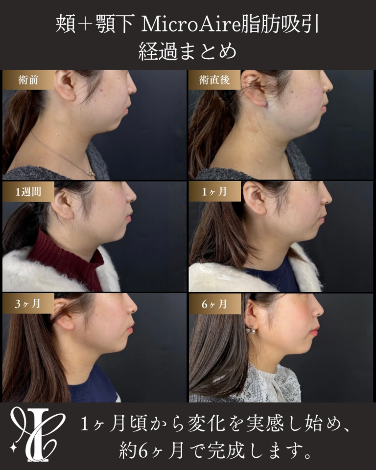 アゴ下+ホホ脂肪吸引 経過まとめ(術直後〜6ヶ月)の症例