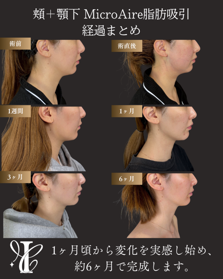 アゴ下+ホホ脂肪吸引 経過まとめ(術直後〜6ヶ月)の症例②