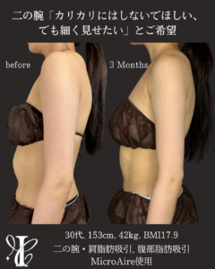 二の腕・肩脂肪吸引 術前術後3ヶ月 側面比較写真