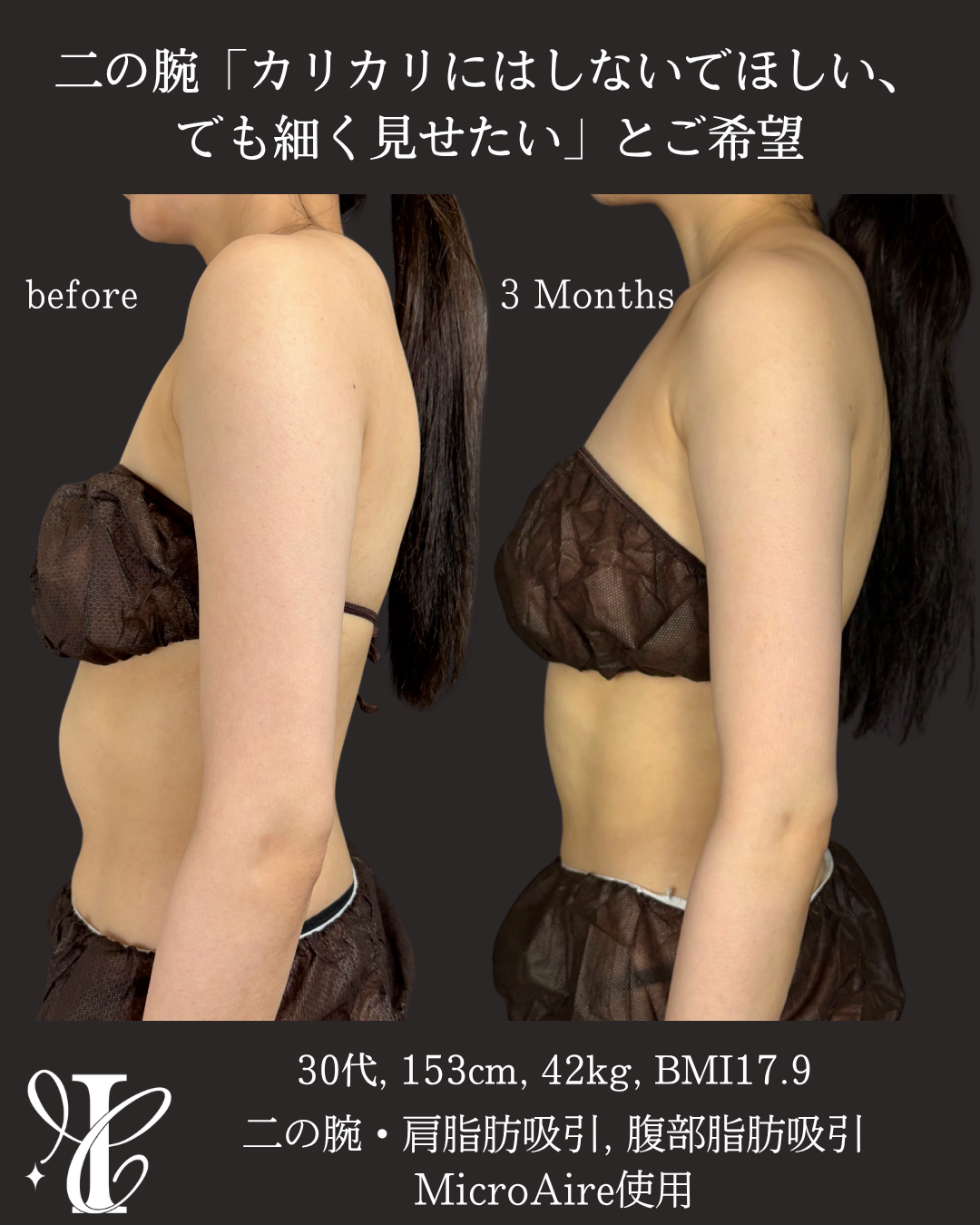 二の腕・肩脂肪吸引 術前術後3ヶ月 側面比較写真