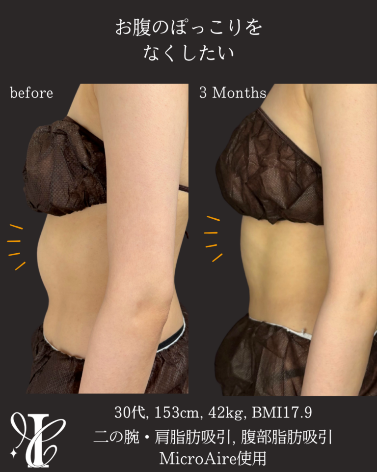 腹部脂肪吸引 術後3ヶ月の症例①(痩せ型のぽっこりお腹)