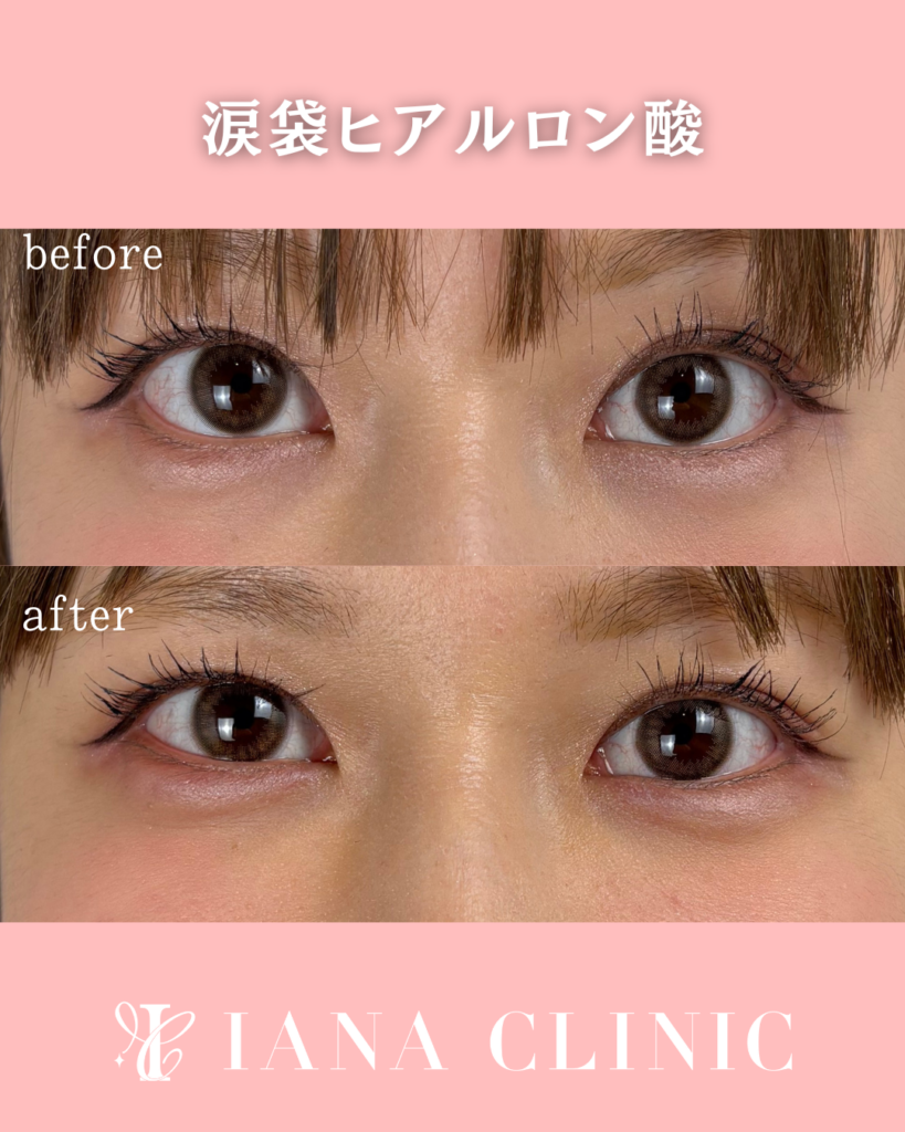 涙袋ヒアルロン酸 術前術後比較写真