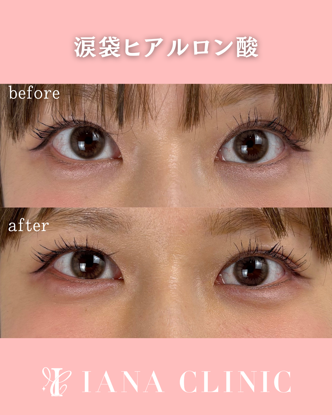 涙袋ヒアルロン酸 術前術後比較写真