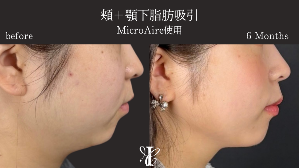 二重あごに対する顔の脂肪吸引の症例写真
