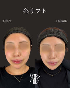 糸リフト 術前術後1ヶ月 正面比較写真