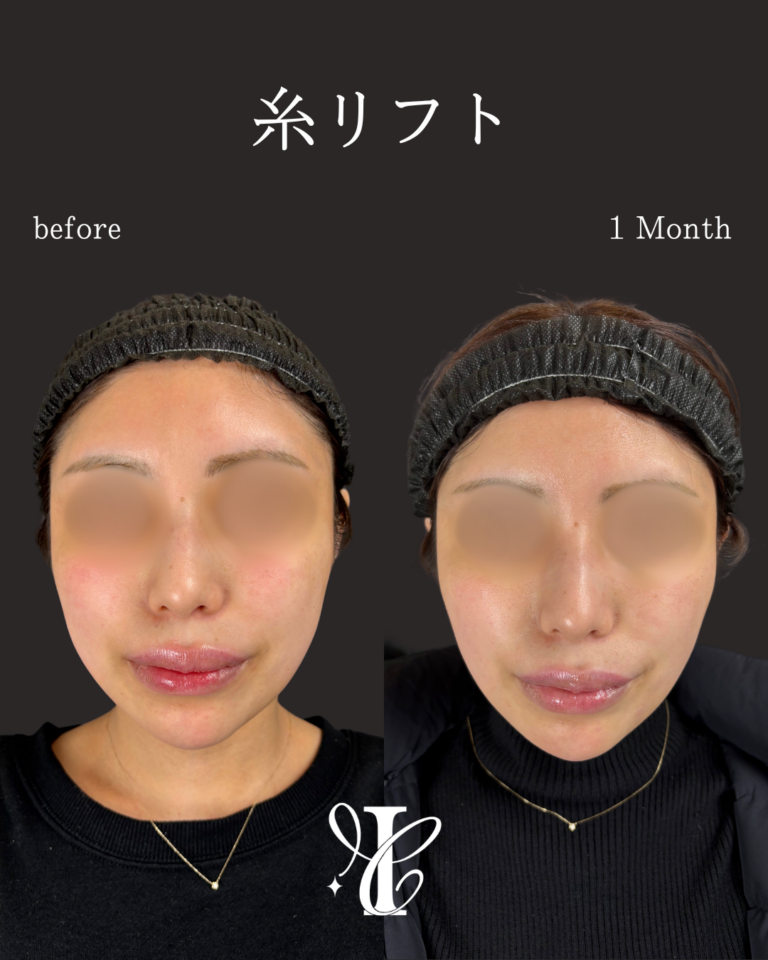 糸リフト 術後1ヶ月の症例①