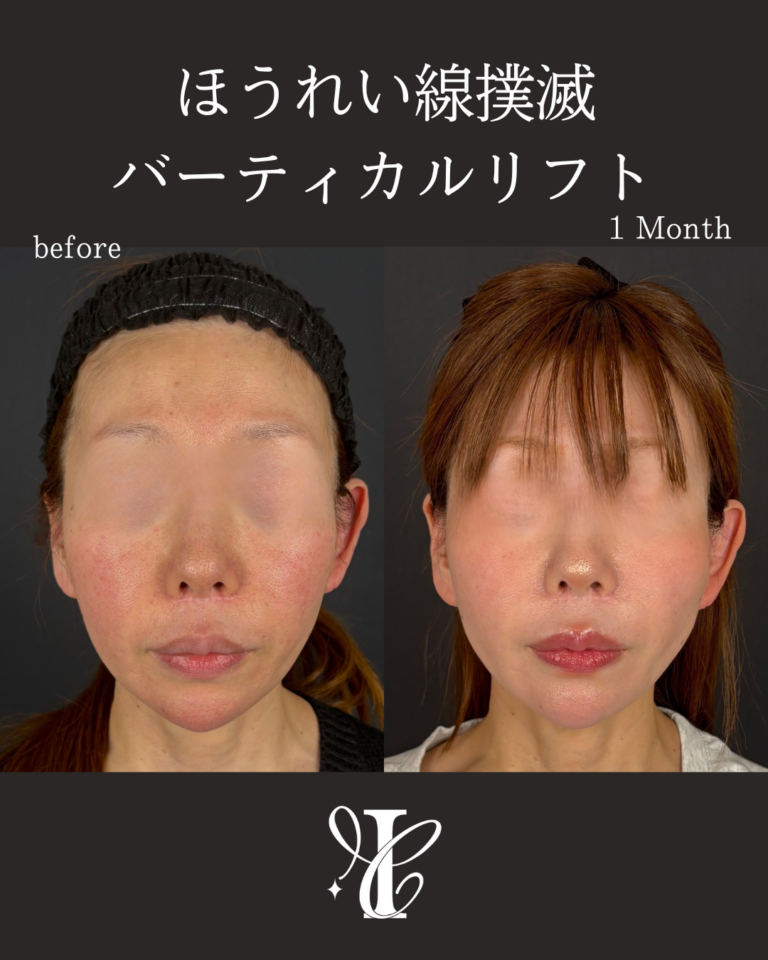 糸リフト バーティカルリフト 術後1ヶ月の症例①