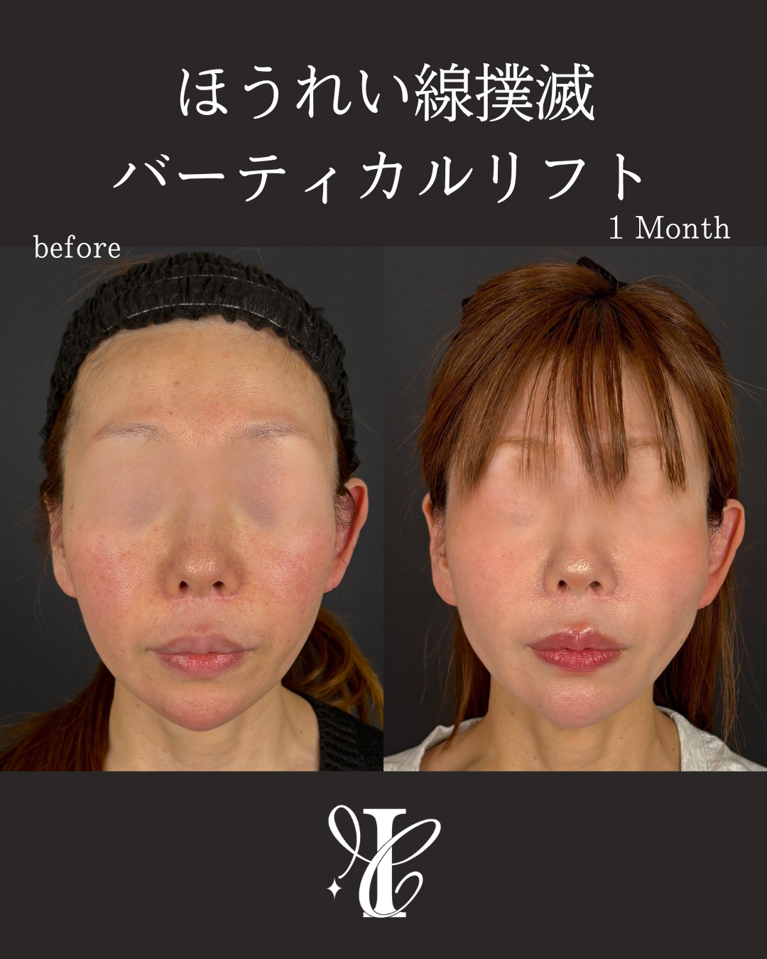 バーティカルリフト 40代 術前術後1ヶ月 正面比較写真