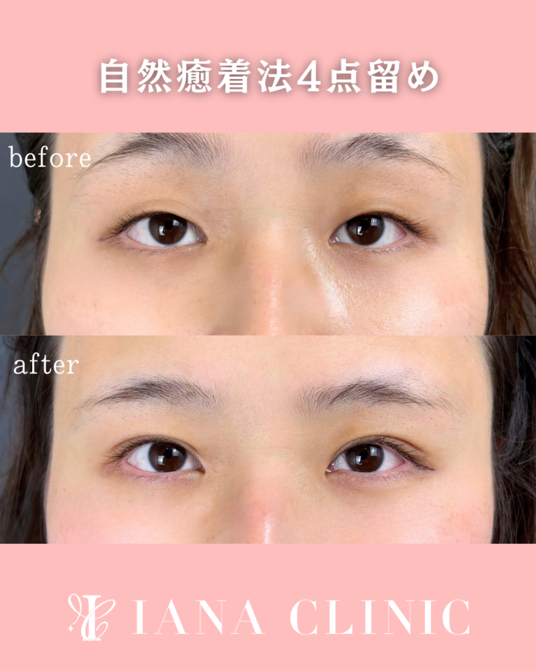二重埋没法(自然癒着法)4点留め 術後1ヶ月の症例③