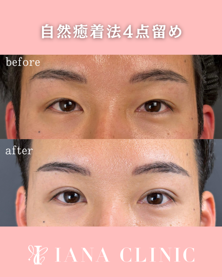 二重埋没法(自然癒着法)4点留め 術後1ヶ月の症例⑧
