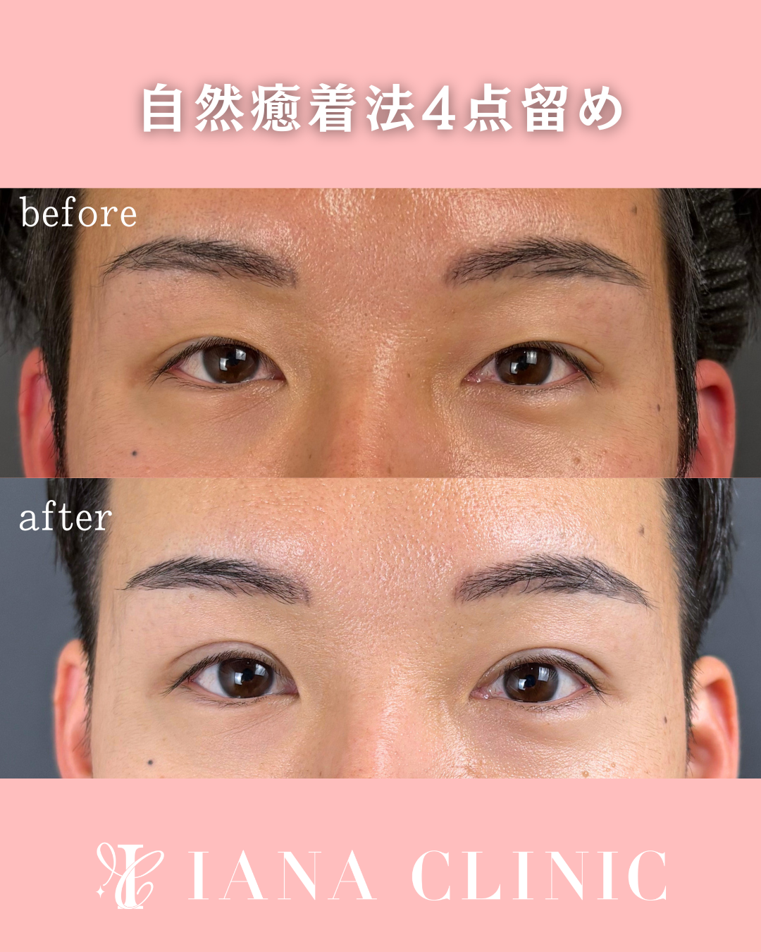 二重埋没法(自然癒着二重埋没法(自然癒着法)4点留め 術前術後1ヶ月 比較写真