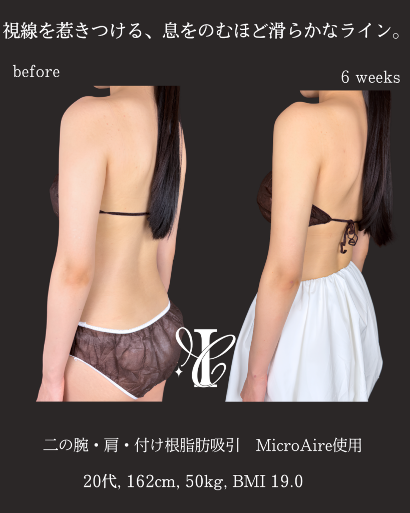 二の腕+肩+付け根脂肪吸引 術後6週間の症例②(斜め後ろ)
