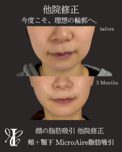 顔の脂肪吸引 他院修正 術前術後3ヶ月 正面比較写真