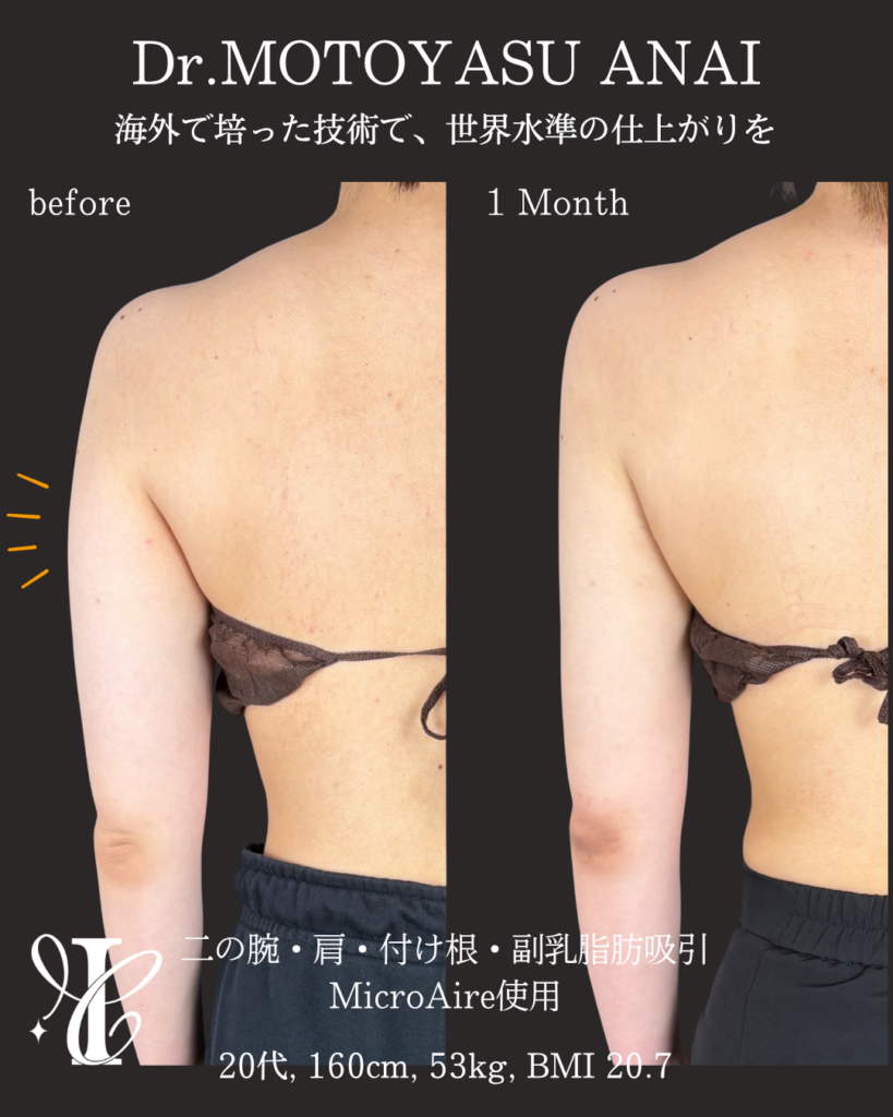 二の腕・肩・付け根+副乳脂肪吸引 術後1ヶ月の症例①(後面)