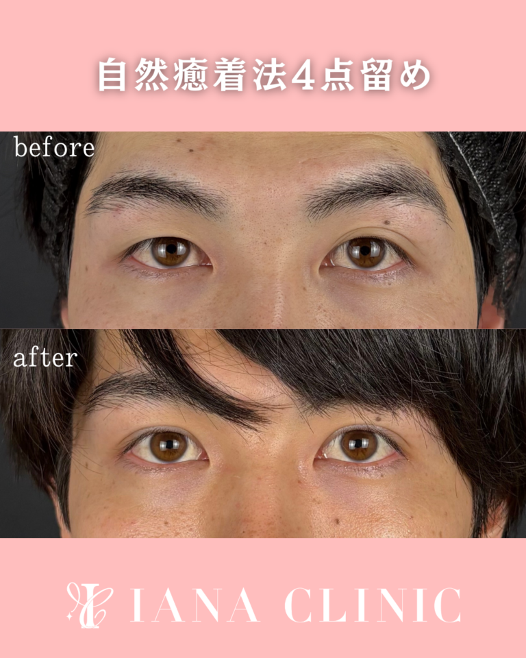二重埋没法(自然癒着法)4点留め 術後1ヶ月の症例⑨