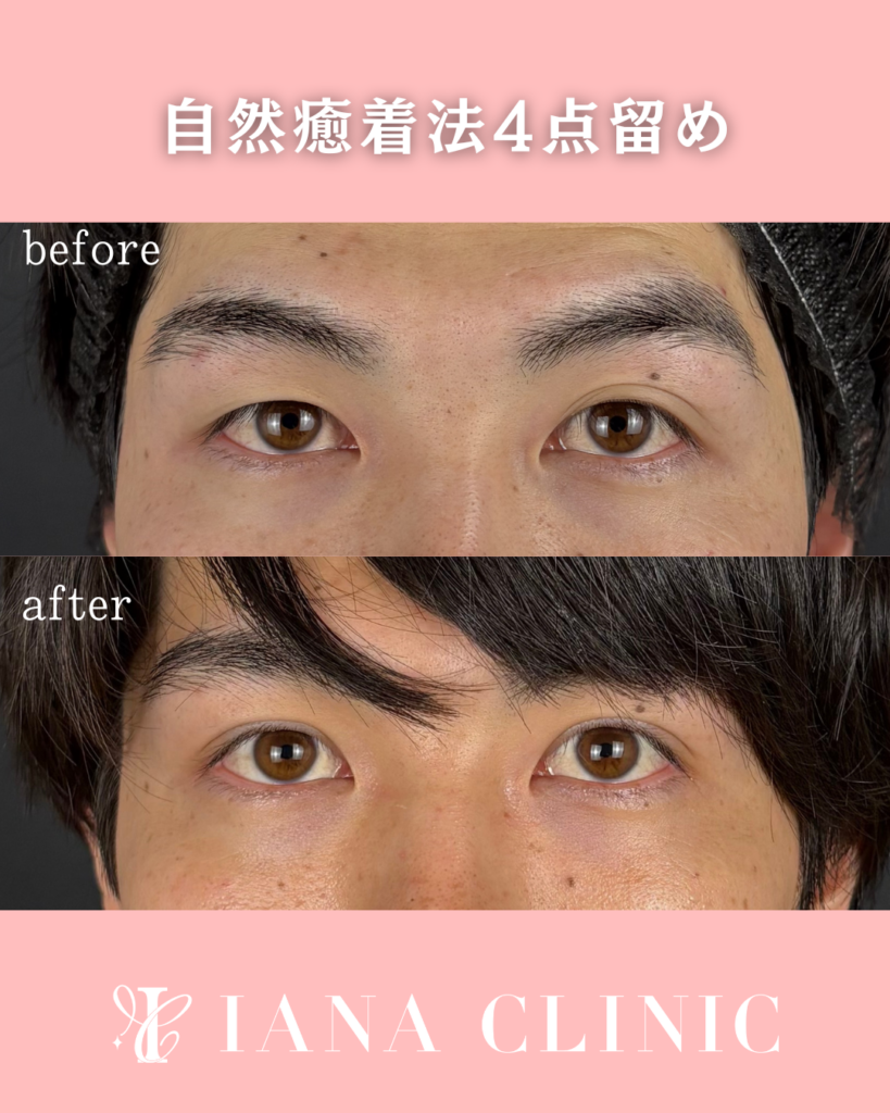 二重埋没法(自然癒着法)4点留め 術前術後1ヶ月 比較写真