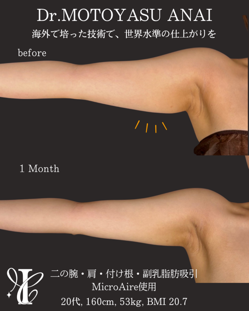 二の腕・肩・付け根+副乳脂肪吸引 術後1ヶ月の症例①(腕を上げた状態)