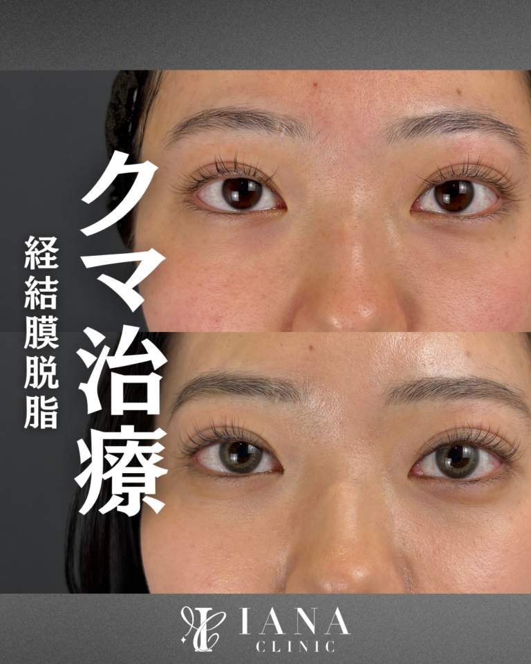 経結膜脱脂 術後1ヶ月の症例③