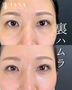 裏ハムラ法 術前術後1ヶ月 比較写真