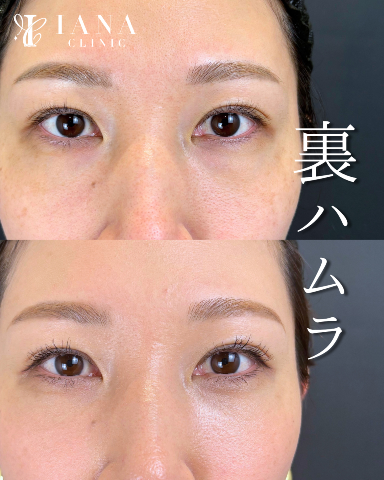 裏ハムラ法 術後1ヶ月の症例②