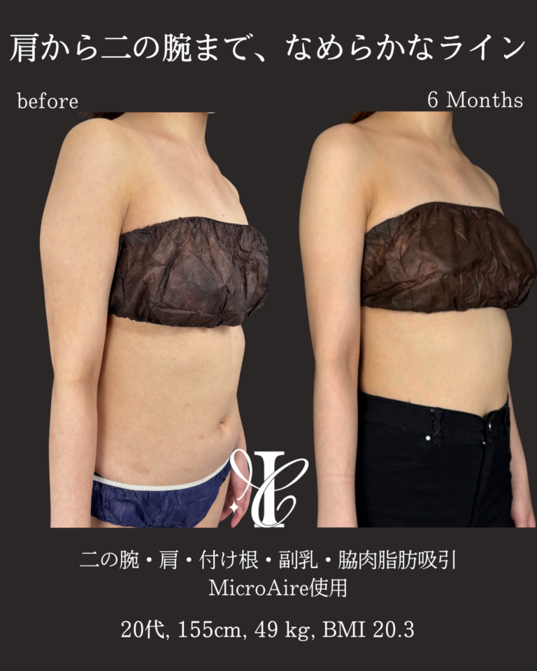 二の腕・肩・付け根+副乳・脇肉脂肪吸引 術後6ヶ月の症例①(斜め)