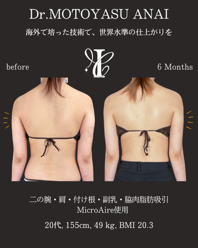 二の腕・肩・付け根+副乳・脇肉脂肪吸引 術後6ヶ月の症例①(後面)