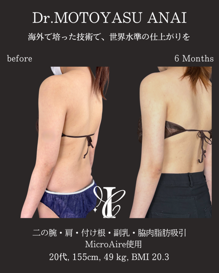 二の腕・肩・付け根+副乳・脇肉脂肪吸引 術後6ヶ月の症例①(斜め後ろ)