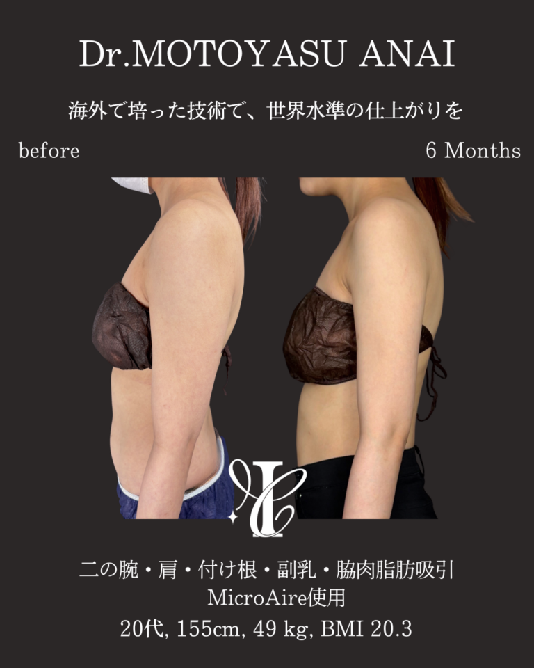 二の腕・肩・付け根+副乳・脇肉脂肪吸引 術後6ヶ月の症例①(側面)