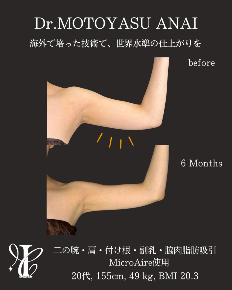 二の腕・肩・付け根+副乳・脇肉脂肪吸引 術後6ヶ月の症例①(腕を上げた状態)