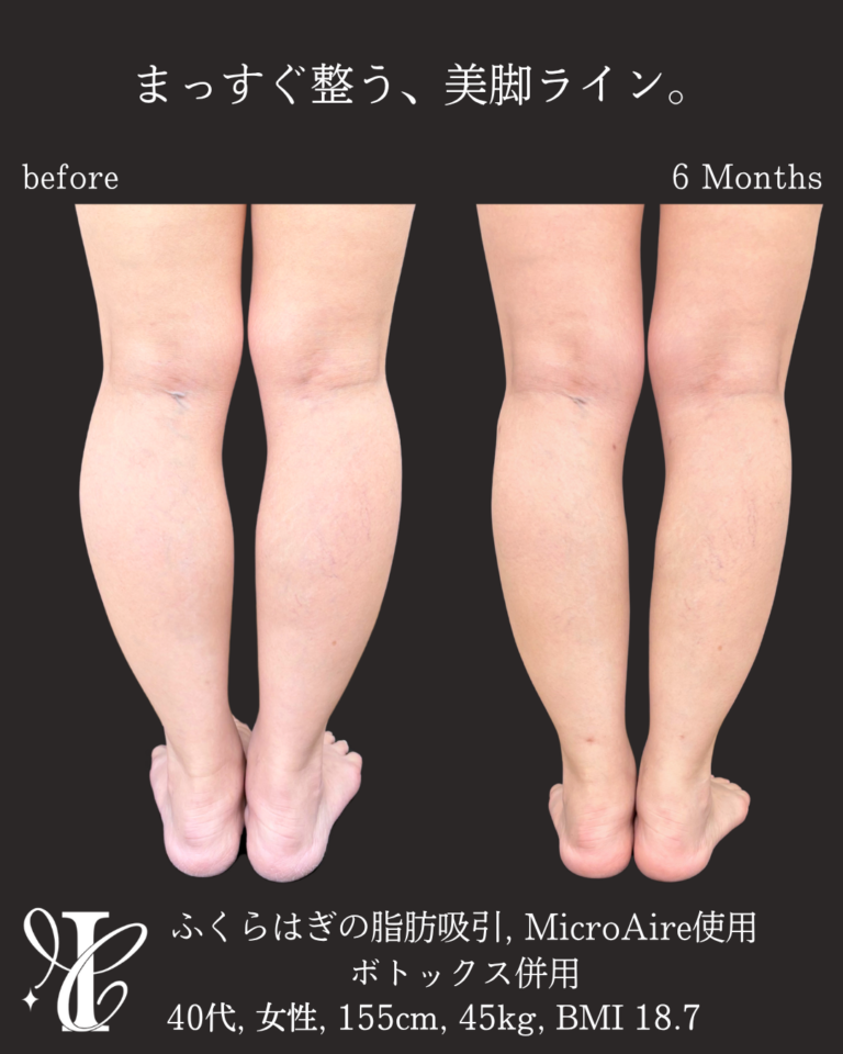 ふくらはぎ脂肪吸引 術後6ヶ月の症例①(ボトックス併用)