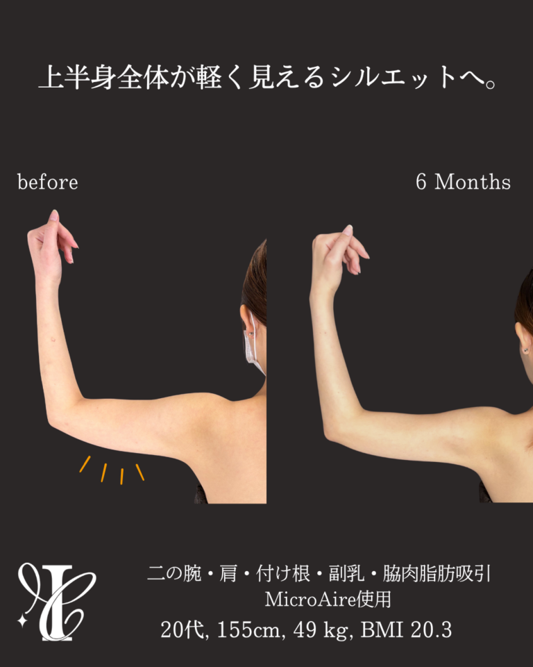 二の腕・肩・付け根+副乳・脇肉脂肪吸引 術後6ヶ月の症例①(腕を上げた状態)