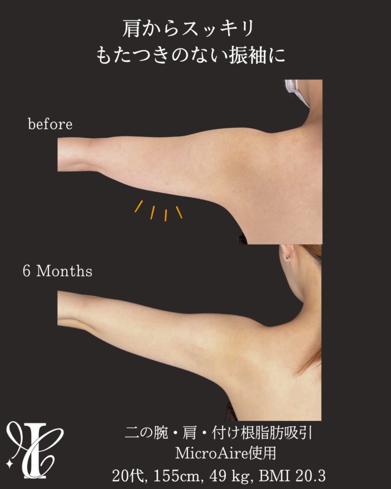 二の腕・肩・付け根+副乳・脇肉脂肪吸引 術後6ヶ月の症例①(振袖)