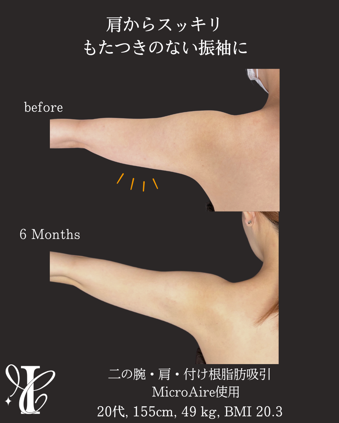 振袖部分の脂肪吸引の術前術後6ヶ月・腕を伸ばした状態の比較写真