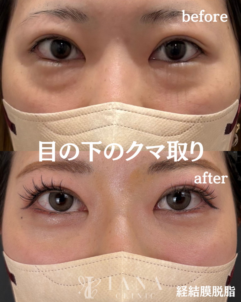 経結膜脱脂 術後1ヶ月の症例②