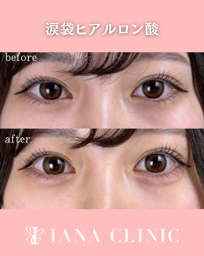 涙袋ヒアルロン酸 術前術後比較写真