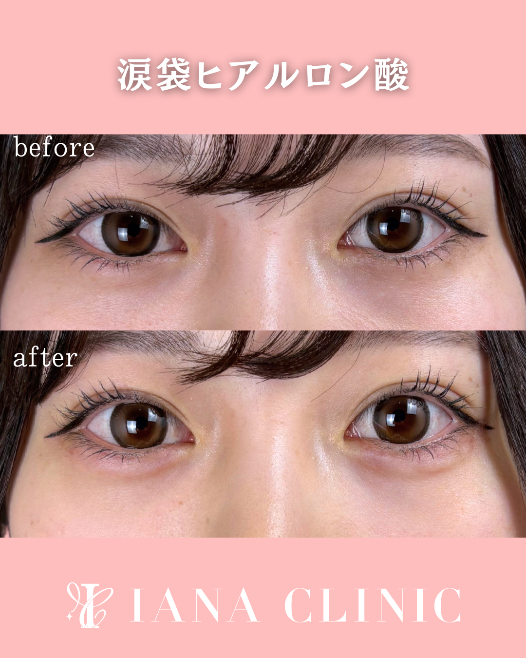 涙袋ヒアルロン酸 術前術後比較写真