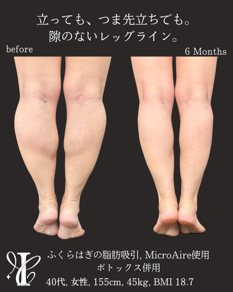 ふくらはぎ脂肪吸引 術後6ヶ月の症例①(つま先立ち比較)