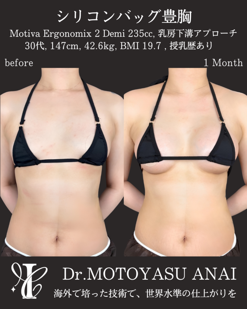 シリコンバッグ豊胸(Motiva Demi 235cc) 術後1ヶ月の症例③