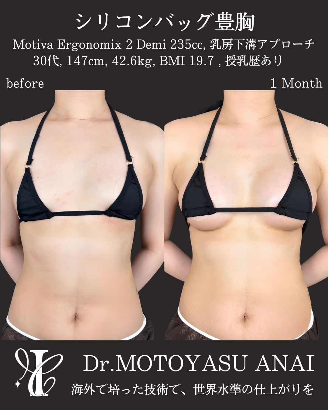 シリコンバッグ豊胸(Motiva 235cc)の術前シリコンバッグ豊胸(Motiva 235cc)の術前術後1ヶ月・正面比較写真