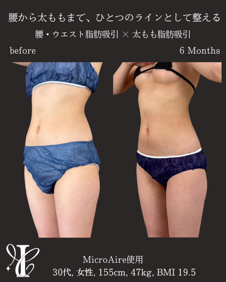 腰・ウエスト+太もも脂肪吸引 術後6ヶ月の症例①(前面)