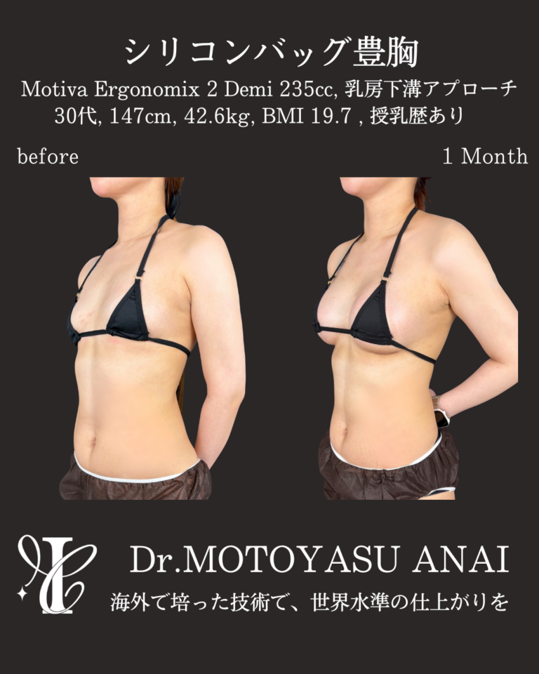 シリコンバッグ豊胸(Motiva Demi 235cc) 術後1ヶ月の症例③(斜め)